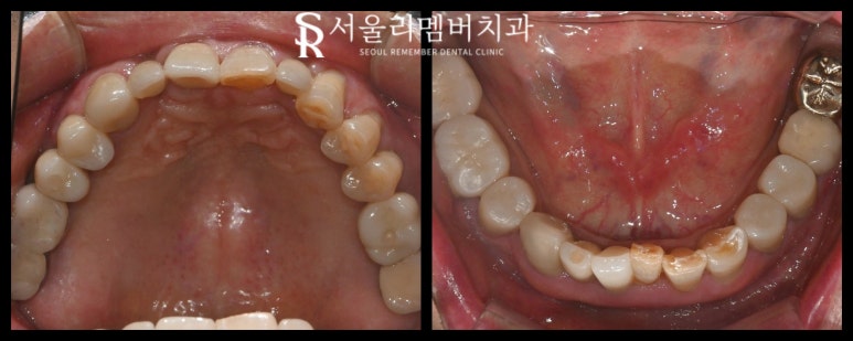 상도동 치과 다수의 충치, 임플란트와 신경치료 한 사례 (치경부 치석 관리의 중요성) 관련 이미지 4