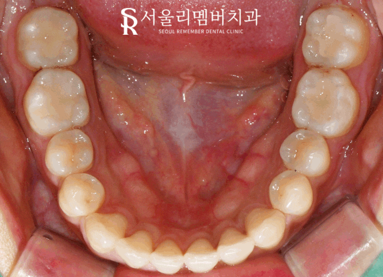 오래된 아말감 신림 치과 수면(의식하 진정) 마취 후 스트라우만 나이스 인레이로 교체 (좌우 2회로 나누어 진행 가능) 관련 이미지 7