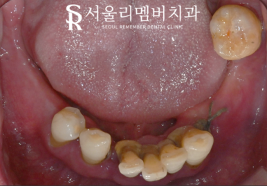 여러 곳이 결손된 치아 서울대입구역 치과 에서 다수 임플란트 식립으로 불편감을 개선해 드린 케이스 관련 이미지 3
