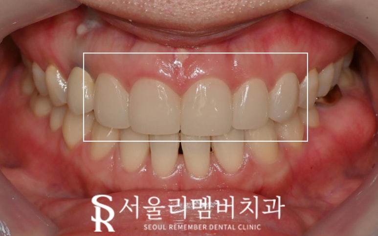 상도동 치과 "진짜(real, 리얼) 같은 자연스러움" 개인 맞춤형 무삭제 라미네이트 관련 이미지 4