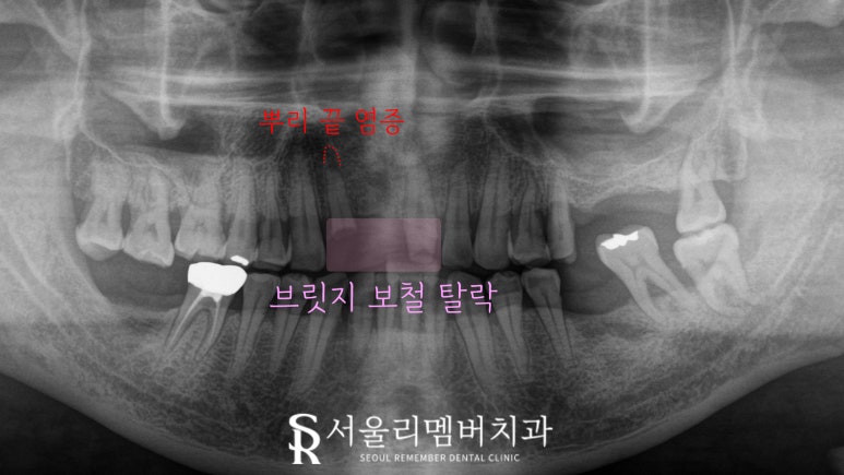 서울대입구 치과 환한 웃음을 되찾는 여정: 앞니 브릿지 탈락부터 임플란트를 통한 새로운 미소까지 관련 이미지 2