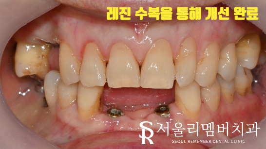 사러가사거리 치과 잇몸이 패이는 치경부 마모증, 어떻게 개선할 수 있을까? 관련 이미지 3