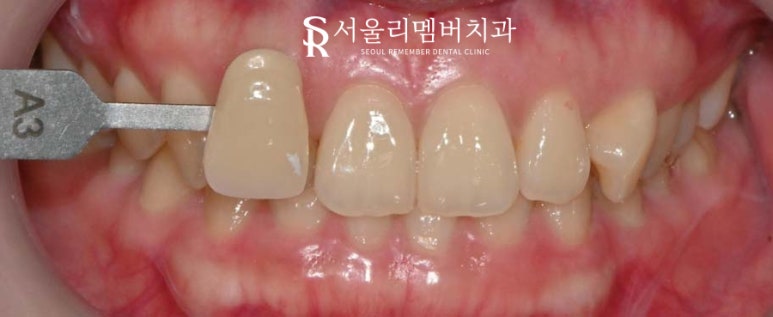 누런치아 되돌리는 뚜렷한 효과! 치아미백 잘하는 서울대입구역 치과 관련 이미지 1