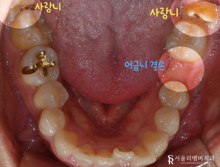 상실된 작은 어금니와 사랑니가 있을 때, 사당 치과 임플란트 및 안전한 발치 과정은? 관련 이미지 2