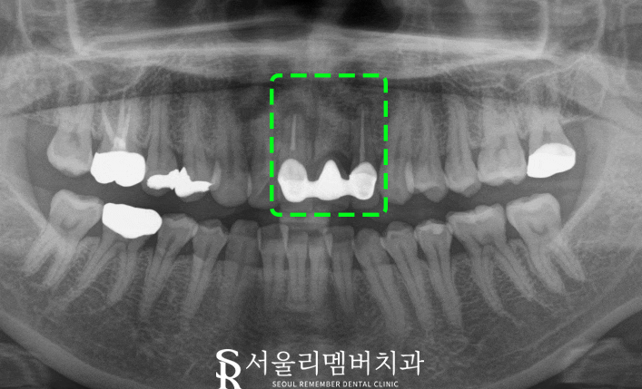 신림역 치과 염증으로 흔들리는 앞니, 심미적인 전치부 임플란트 식립 증례 관련 이미지 2