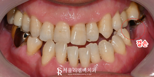 신림역 치과, 어금니 임플란트 및 보철 치료로 심미 저작 기능 개선 과정 관련 이미지 1