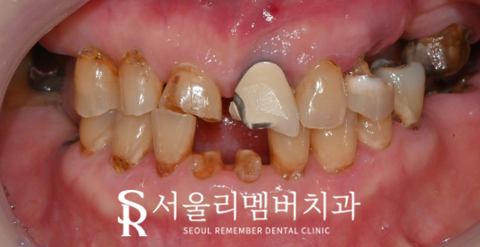 서울대입구역 치과 에서 수면(의식하진정)요법 동반한 전체 임플란트 식립 관련 이미지 2