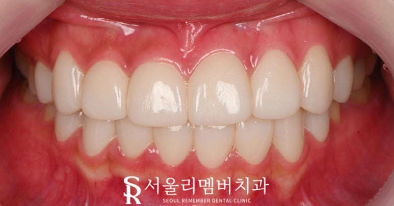 사당역 치과 리얼네이트 심미보철 라미네이트로 누렇고 약한 앞니부터 작은 어금니까지 변화 관련 이미지 5