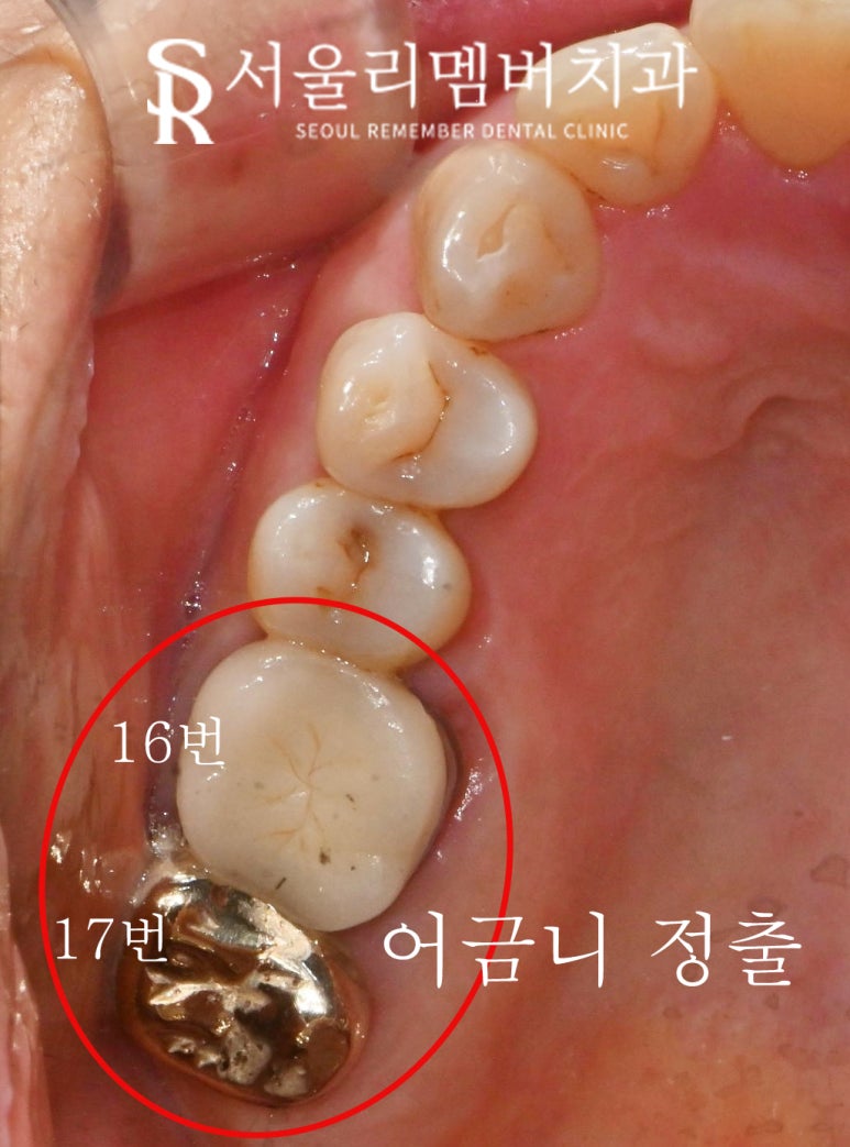 봉천역 치과 어금니 보철 후 음식물 끼임 및 치아 파절, 신경치료 크라운 및 임플란트 관련 이미지 5