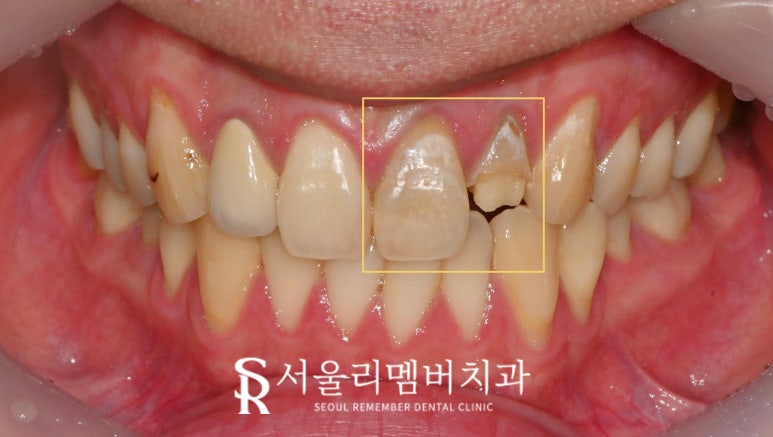신대방 치과 앞니 충치와 약해진 치아 신경치료 크라운 및 부러진 측절치 발치 임플란트 관련 이미지 1