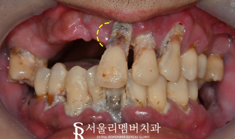"도저히 음식을 먹지 못해요" 봉천역 치과 수면 임플란트 치료 사례 관련 이미지 1