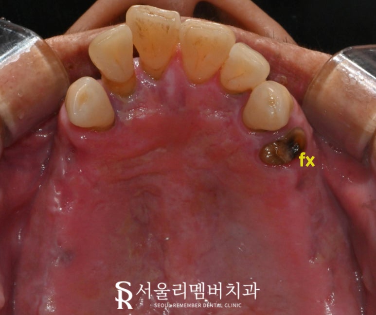 서울대입구역 양심 치과, 최소 비용으로 전체 임플란트 수술 관련 이미지 2