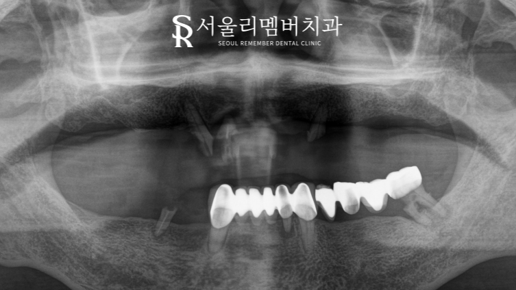 전체 보철을 할 수 밖에 없었던 이유, 서울대입구역 치과 교합 되살리기 관련 이미지 1