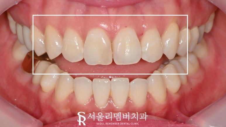 Concerned About the Color and Shape of Your Front Teeth? Seoul National University Station Dental Clinic—Maxillary Six Anterior Veneers Extending to the Canines image 2