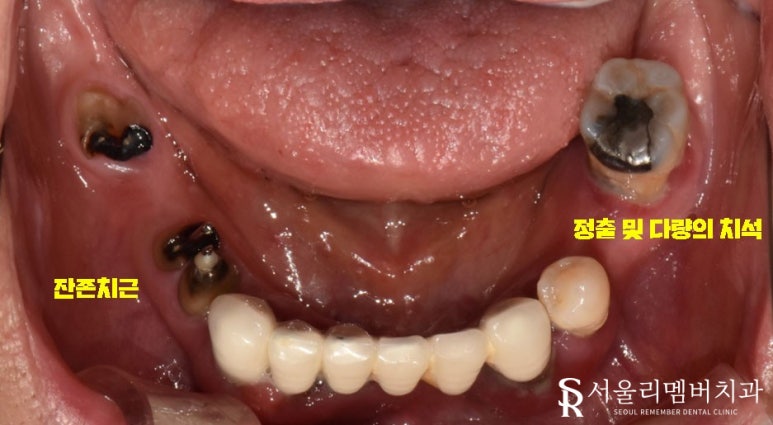 금방이라도 빠져버릴 것 같은 치아들, 전체임플란트 식립으로 개선했던 이야기. 이수역 서울 리멤버 치과 관련 이미지 3