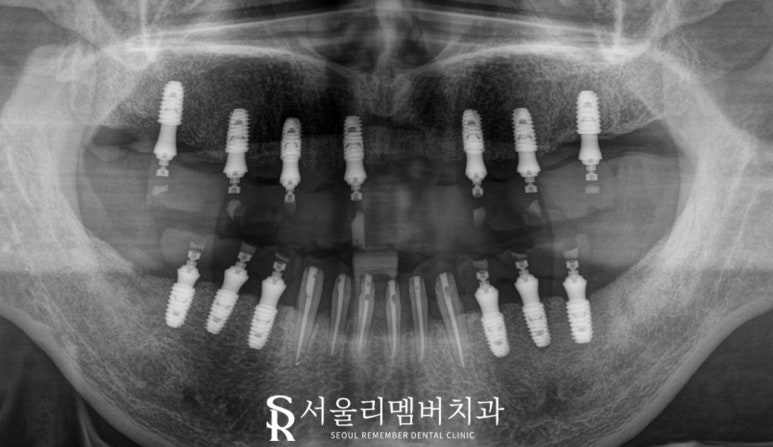 사당 치과 하악 전치 신경치료 브릿지로 살리고 나머지 임플란트로 재건한 전악 증례 관련 이미지 9