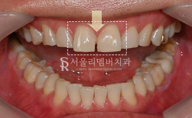낙성대 치과 레진 탈락으로 인한 앞니 벌어짐(다이아스태마), 당일 치료 과정 관련 이미지 1