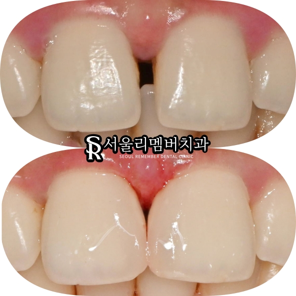 신림 치과 벌어진 앞니 정중이개 다이아스태마 레진 당일 충전 치료 관련 이미지 3