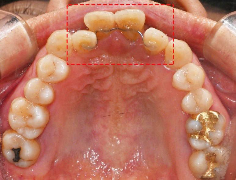 보라매 치과 삐뚤어진 교합 불량 앞니, 임플란트로 가지런하게 만들어드린 사례 관련 이미지 3