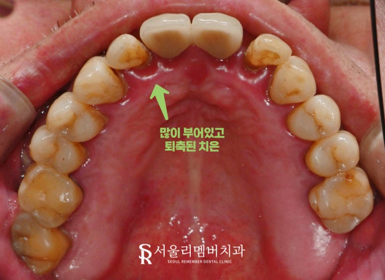 서울대입구역 치과 잇몸이 내려앉아서 고민이라면 전악 임플란트로 해결 관련 이미지 3