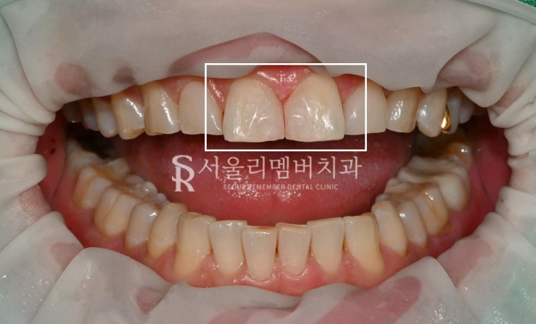 낙성대 치과 레진 탈락으로 인한 앞니 벌어짐(다이아스태마), 당일 치료 과정 관련 이미지 2