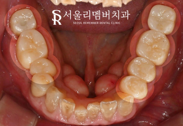 서울대입구역 치과 어금니 상실로 무너진 수직 고경과 과개 교합, 신경치료 크라운과 임플란트로 개선할 수 있다면 관련 이미지 6