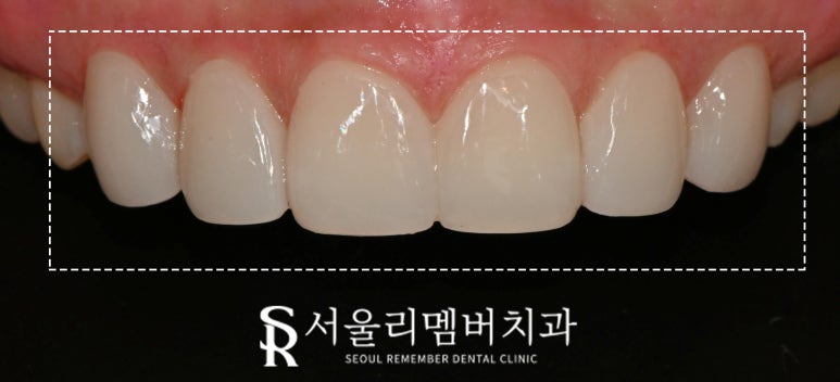 서울대입구역 치과 결혼 앞둔 예비 신부 주목! 누런 앞니, 모양 마음에 들지 않는다면 무삭제 라미네이트로 해결 관련 이미지 2