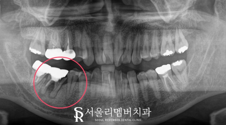 치아 깨지고 통증 있을 때, 서울대입구역 치과 파절 정도에 따른 신경치료 크라운 및 발치 임플란트 관련 이미지 5