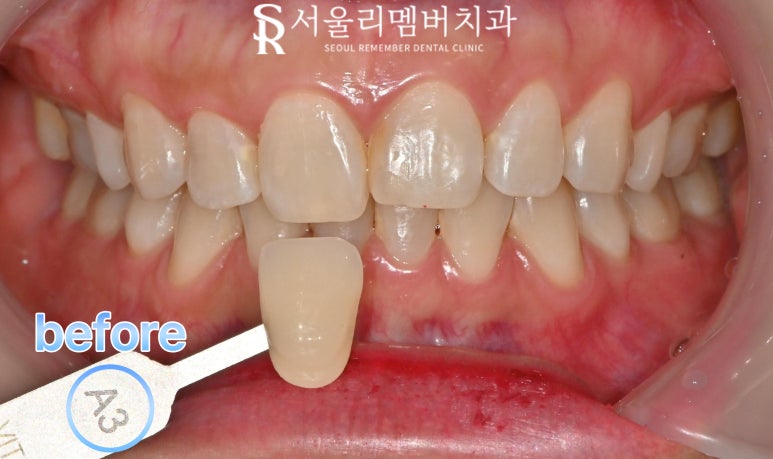 Can Teeth Be Brightened with Scaling and Whitening in One Day on the Same Day? Bongcheon-dong Dentist image 2