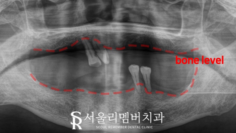신대방 치과 고난도 전악 임플란트 수술 가능 관련 이미지 1