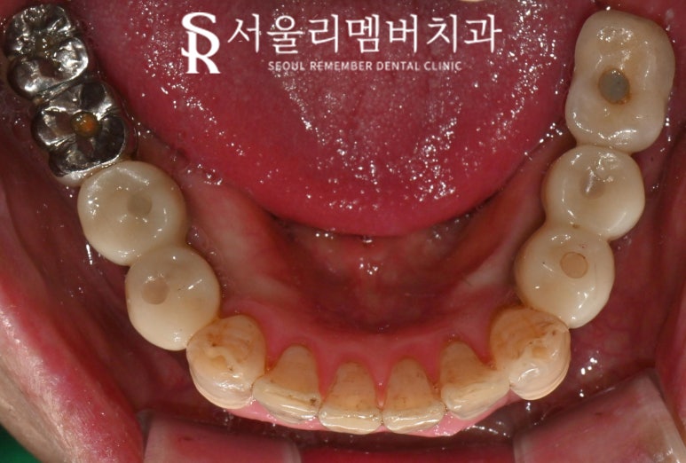 서울대입구역 치과 "부분틀니에서 임플란트로" 바꿔서 전악 개선해 드린 증례 관련 이미지 8