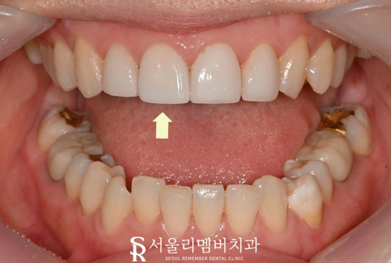 서울대입구역 치과, 깨진 앞니 라미네이트 한 개만 교체 치료 가능할까요? 관련 이미지 3