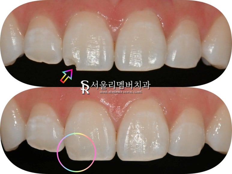 사당 치과 앞니 살짝 깨짐 절단연 파절, 당일 레진 충전으로 심미성 회복 관련 이미지 3
