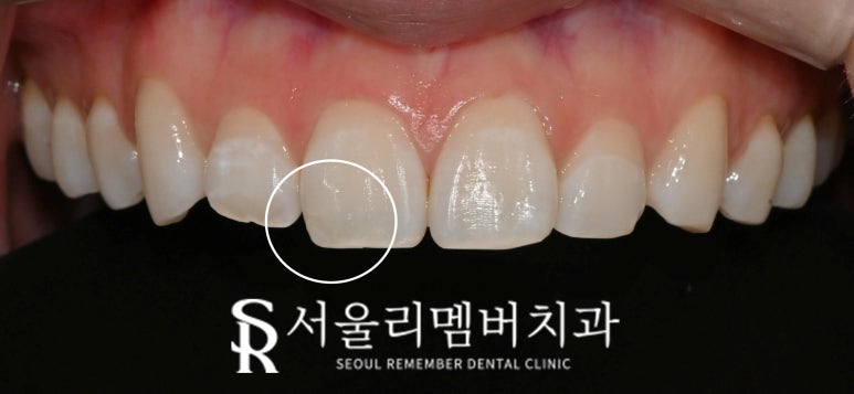 사당 치과 앞니 살짝 깨짐 절단연 파절, 당일 레진 충전으로 심미성 회복 관련 이미지 2