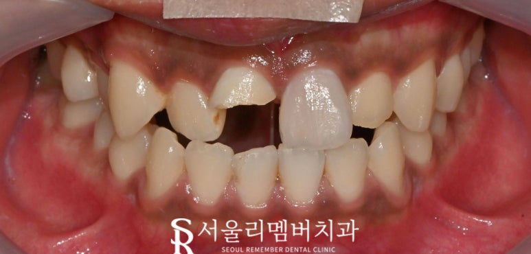 심하게 부러진 앞니의 해결 방안은? 상도동 치과 신경치료 과정 통해 알 수 있습니다. 관련 이미지 1