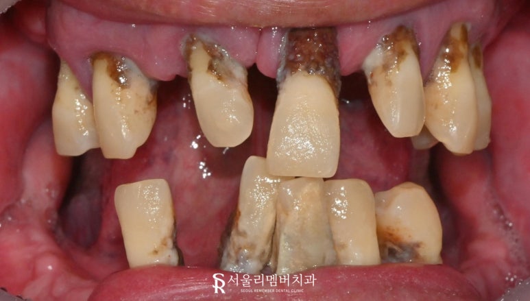 상도동 치과 위아래 다수의 치아 상실, 원가이드를 이용한 디지털 임플란트 로 상하악 전체 재건 가능 관련 이미지 1