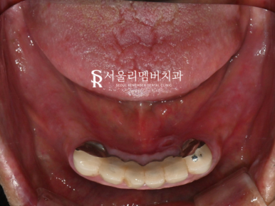 서울대입구역치과 수면마취를 사용한 전체 임플란트 식립 과정 관련 이미지 3