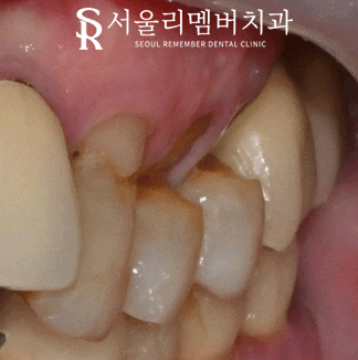서울대입구역 치과 에서 작은 어금니 깊은 파임, 신경치료 후 통증 없는 크라운 진행 과정 알려드립니다. 관련 이미지 1