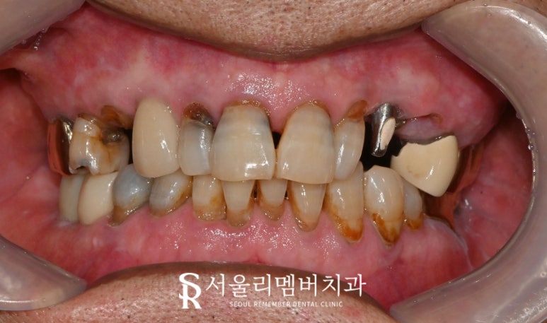 사당역 치과 충치, 치아 흔들림, 파절, 결손, 염증.. 다수의 복합 문제 생겼다면 임플란트 신경치료 크라운 과정 관련 이미지 1