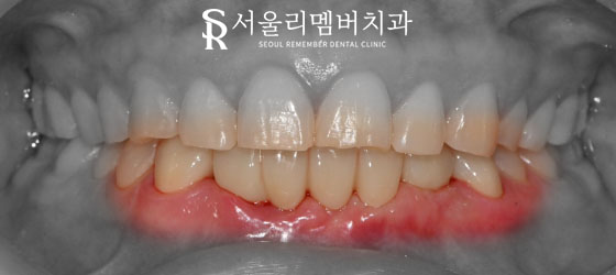 서울대입구역치과 에서 아래 앞니 5개를 임플란트 2개만으로 자연스럽게 회복 관련 이미지 8