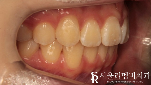 인비절라인을 사용한 치아 총생 개선 증례! 청룡동 치과 관련 이미지 11