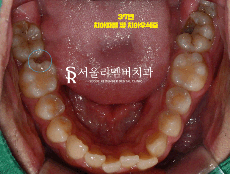 서울대입구역 치과 근관치료 증례 관련 이미지 1