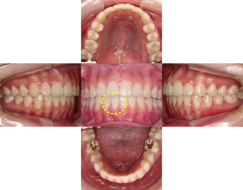 튀어나온 앞니 치료 후 관련 이미지 1