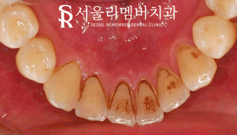 사당 치과 치석 및 착색 제거 연 1회 보험 스케일링 비용 가격 통증 시간 식사 음주 관련 이미지 1