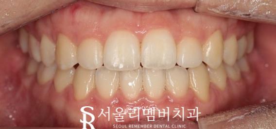 서울대입구역 치과 툭 튀어나온 돌출 때문에 발치교정 진행 관련 이미지 8