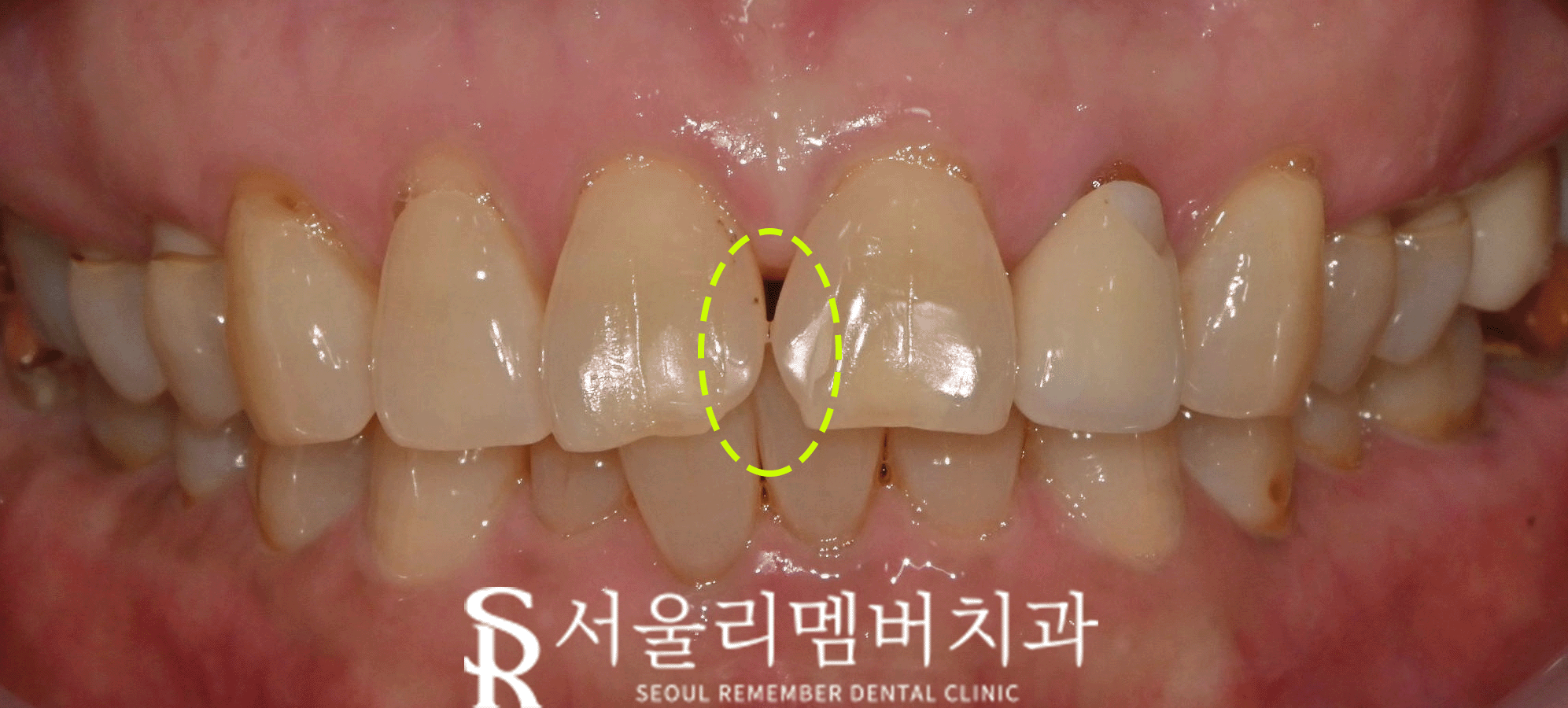 서울대입구역 치과, 벌어진 치아를 당일에 치료하는 방법. 정중이개 레진 수복 관련 이미지 3