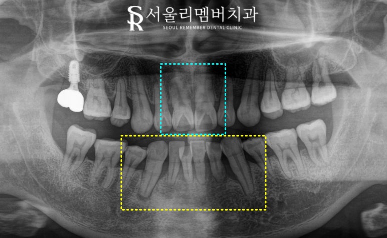 신림역 치과 앞니 크라운 및 임플란트 필요할 때 고려해야 될 요소 (비용, 기간, 개수 etc) 관련 이미지 2