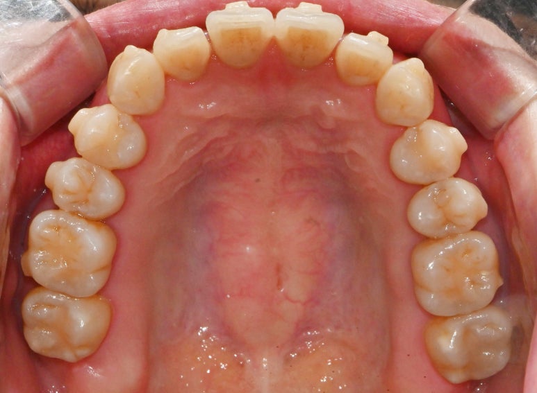 선천적 영구치 결손으로 남아있는 만기 잔존 유치, 서울대입구역 교정 치과 에서 투명 인비절라인 & 임플란트 케이스 관련 이미지 7