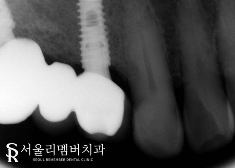 서울대입구역 치과 음식 찌꺼기가 계속 껴요. 관련 이미지 3
