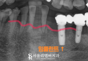 아래 앞니 임플란트 수명 얼마나 될까? 서울대입구역치과 에서 제대로 된 치료 받으세요. 관련 이미지 3